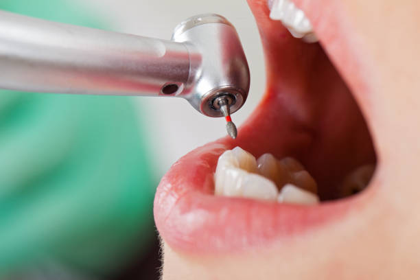 Best Emergency Broken Tooth Repair in San Diego, CA